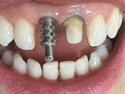 implant-plus-szlif.jpg-1698863112.jpg